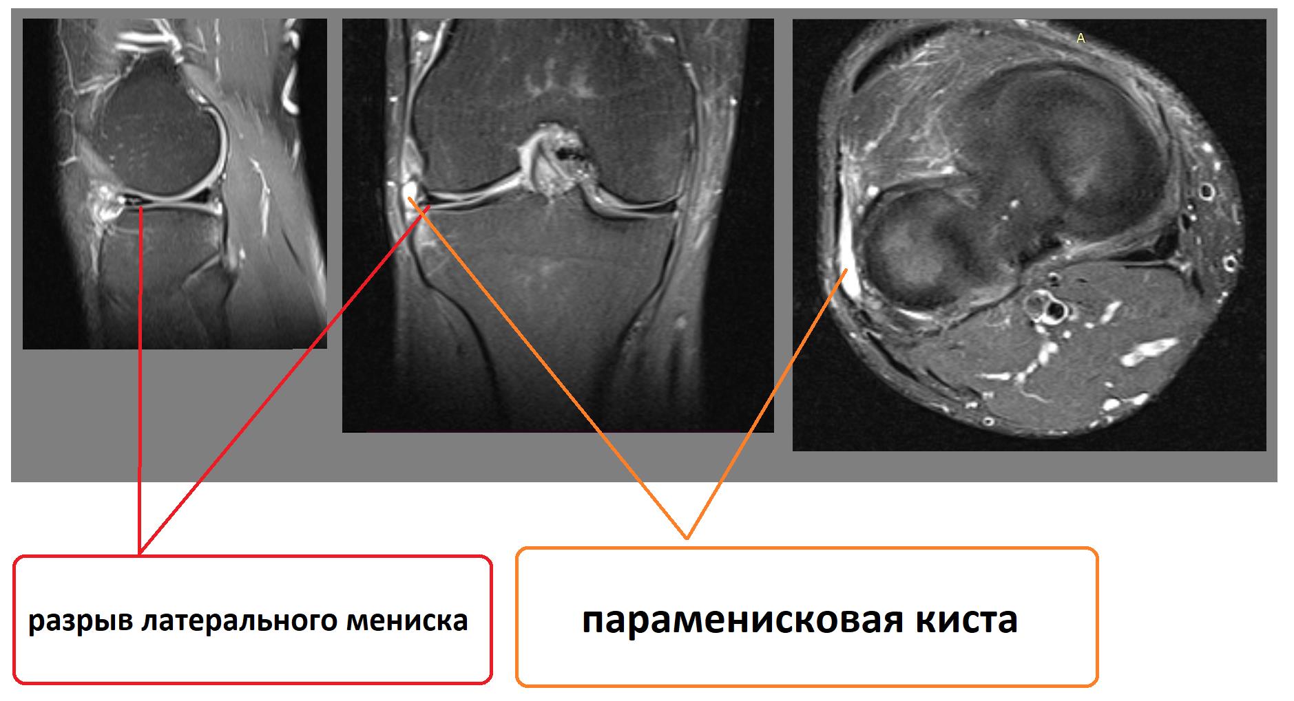 Разрыв коленного мениска фото